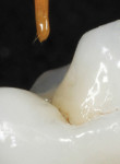 The prosthesis is placed on the abutment, then the brush is loaded with an opaque brown or white stain and lowered to the crown. Note the small concavity created on the occlusal surface to receive the stain; this ensures that the screw-access marking will not wear away under load.
