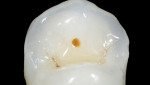 The screw-access marking clearly indicates the precise location of the screw access through the occlusal surface of the restoration. If the prosthesis needs to be removed at any future
date, the screw can be easily and predictably
accessed by creating a hole at that location.