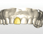 A virtual representation of the desired crown from model scan.