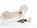 Before surgery, DENTSPLY Implants sends the SIMPLANT Guide to the clinician and the patient-specific abutment and temporary crown to the laboratory.
