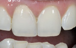Figure 17  Image of a single central (tooth No. 8) inVizion crown (inVizion is the trade name for the VITA YZ material and the CEREC inLab CAD/CAM system).