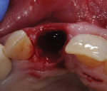 The alveolus after careful extraction of central incisor.