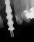 An implant-level impression for abutment and final crown.