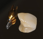 The final ATLANTIS Abutment in gold-shaded titanium, as well as the final crown based on the implant-level impression.