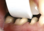 Figure 19  Using the Kerr 2-mm Reduction Guide to judge occlusal reduction.