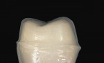 Figure 20  Image of ideal preparation for scanning and machining. Note the very rounded occlusal line angles and generally flatter occlusal preparation than what might have been for a PFM.