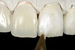 Figure 21  Layering zirconia porcelain on a refractory die for porcelain veneer fabrication.