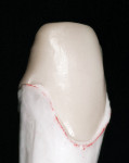 Figure 23  A zirconia framework on the die demonstrating a 0.5-mm facial cutback of the core for a porcelain margin.