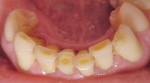 Figure 1  The worn mandibular incisors demonstrate loss of incisal embrasure form.