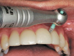 Figure 6  The reciprocating handpiece with the Lamineer being used to remove excess cement in difficult to access areas with a Lumineer porcelain veneer restoration.