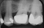 Figure 10  Radiographic view of the reshaped and marginated overhang.