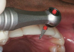 Figure 16  Shaping the incisal embrasure of a minimally invasive Lumineer porcelain veneer with the Lamineer 