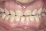 Figure 1 Extensive wear of tooth structures.