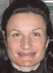 Figure 2 Facial view with reduced occlusal vertical dimension.