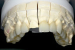 Figure 12 Lithium-disilicate restorations on the model and demonstration of incisal length increase.