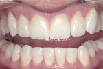 Figure 14 Retracted frontal view of maxillary lithium-disilicate restorations and mandibular direct resin composites.