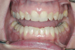 Figure 2 Currently active attrition of upper and lower incisors.