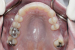 Figure 3 Upper arch, after recent loss of tooth No. 14 due to biomechanical failure.