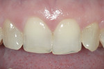 Figure 6 Upper incisors demonstrated thinning, with past attempts of restoring with direct composite.