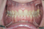 Figure 1 Initial presentation showing maximum intercuspation with approximately 50% overbite.