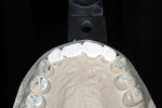 Figure 10 Study-cast demonstration to patient showed amount of tooth structure removal that would be necessary if teeth were not repositioned.