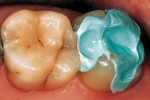 Figure 13  The bite registration taken to create virtual opposing dentition.