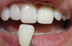 Figure 7. Shades were also compared to tooth No.8 to ensure accuracy, but not exact replication to prevent an unnatural appearance.
