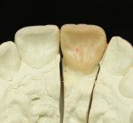 Figure 14. An occlusal view of the wax-up was
needed to further determine contours.