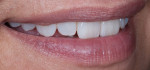 Figure 19. Right lateral image of the restoration tried in patient’s mouth, natural smile view.