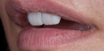 Figure 21. Left lateral view of the restoration tried in the patient’s mouth with lips at rest.