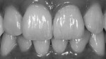 Figure 23. Black and white evaluation with brightened exposure of the all-ceramic restoration during try-in.
