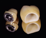 Figure 1. Build-up of a titanium abutment (Steri-Oss) with sintered porcelain to accommodate a glass-ceramic crown with a lithium-disilicate framework.