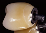 Figure 2. Situation after delivering the glass-ceramic crown to the veneered abutment (technician: Volker Weber, Aachen, Germany).