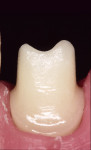 Figure 3. All-ceramic implant abutment on a master cast with artificial gingiva. The abutment was made from highly pure and densely sintered alumina ceramic (Ceradapt, Nobel Biocare). Its emergence profile was modified (technician: Volker Weber, Aachen, Germany) with sintered ceramics (Vitaduralpha, Vita Zahnfabrik).