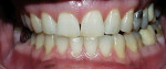 Figure 1a  Pretreatment view using a 15% carbamide peroxide take-home whitening system.