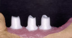 Figure 9. Zirconia abutments after time-consuming customization for all-ceramic crowns.