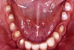 Figure 11. Experimental use of all-ceramic abutments (zirconia and alumina in the third and fourth quadrants respectively) in the posterior mandible (year: 1998).