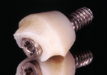 Figure 13. The implant was extensively reduced
with abrasive instruments for correct axial
inclination. Given the means available in laboratories at the time, minimum thickness of the
material could not be adequately controlled.