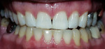 Figure 1b  Posttreatment view using a 15% carbamide peroxide take-home whitening system.