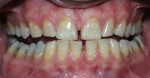Figure 3a  Pretreatment view of a light-activated whitening system.