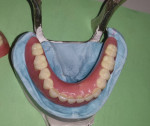 Figure 13. The lower denture was fitted, evaluated for fit and accuracy, and
returned on the master model.