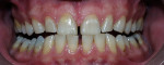 Figure 3c  Both arches at the 7-day recall using a light-activated whitening system.