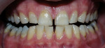 Figure 3d  Both arches at the 30-day recall using a light-activated whitening system.