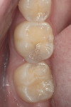 Figure 2 Preoperative view of tooth No. 30.