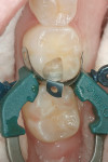 Figure 3 The completed preparation of tooth No. 30 isolated with a sectional matrix system.