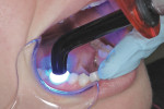Figure 4 Example using a curved light guide to access
tooth No. 30; notice how wide the patient has to open to allow the light beam to
be at 90° to the composite resin.