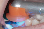 Figure 5 Using the SmartLite Focus to cure the restoration on tooth No. 30.