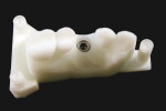 Figure 3 Printed
model with implant analog.