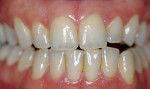 Figure 4b  Posttreatment view using an OTC, light-activated tooth whitening system.