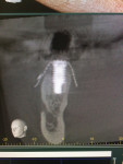 Figure 9 Radiographs from
3-month postoperative visit showing new bone growth.